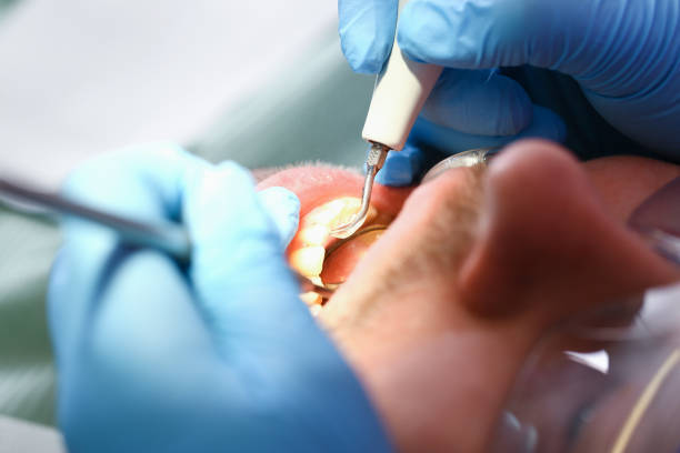 Best Emergency Wisdom Teeth Removal in Frankton, IN
