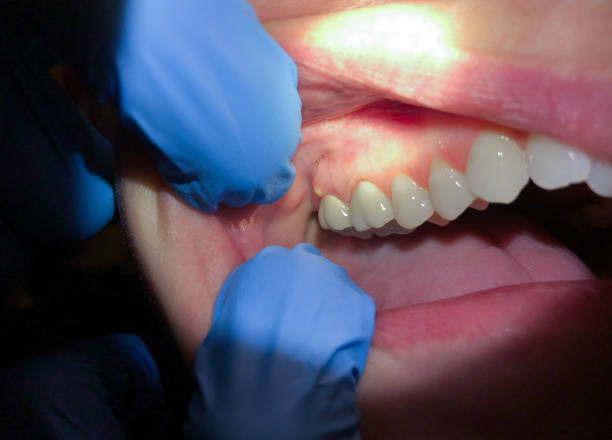 Best Emergency Treatment for Toothache in Frankton, IN
